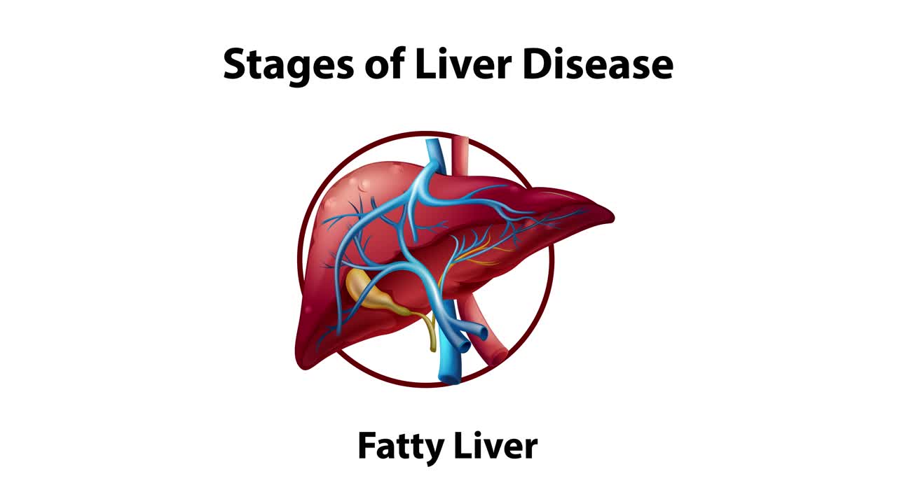 Visual depiction of liver disease stages