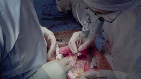 medical staff of the operating unit do heart surgery