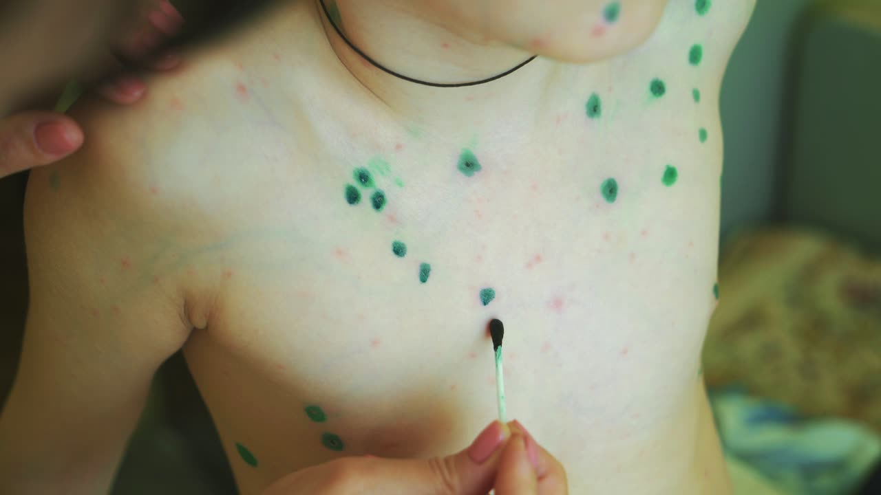 Little boy with chickenpox. Mother applying antiseptic solution to rash. Home treatment.