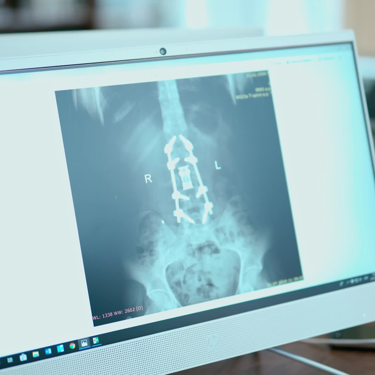 X-ray scan of patient
