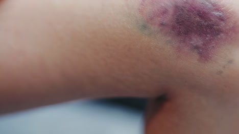 bruised knee