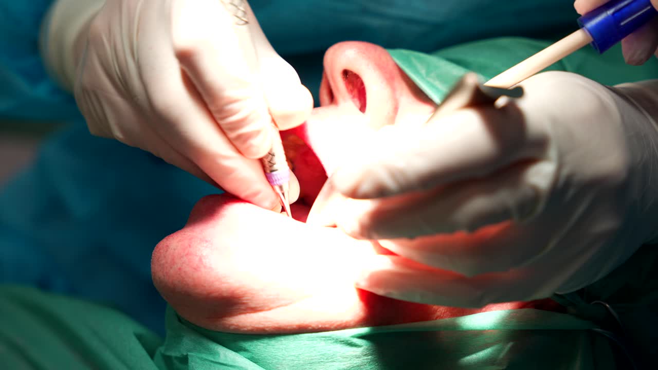 Oral surgeon cleaning tooth area before installing dental implant