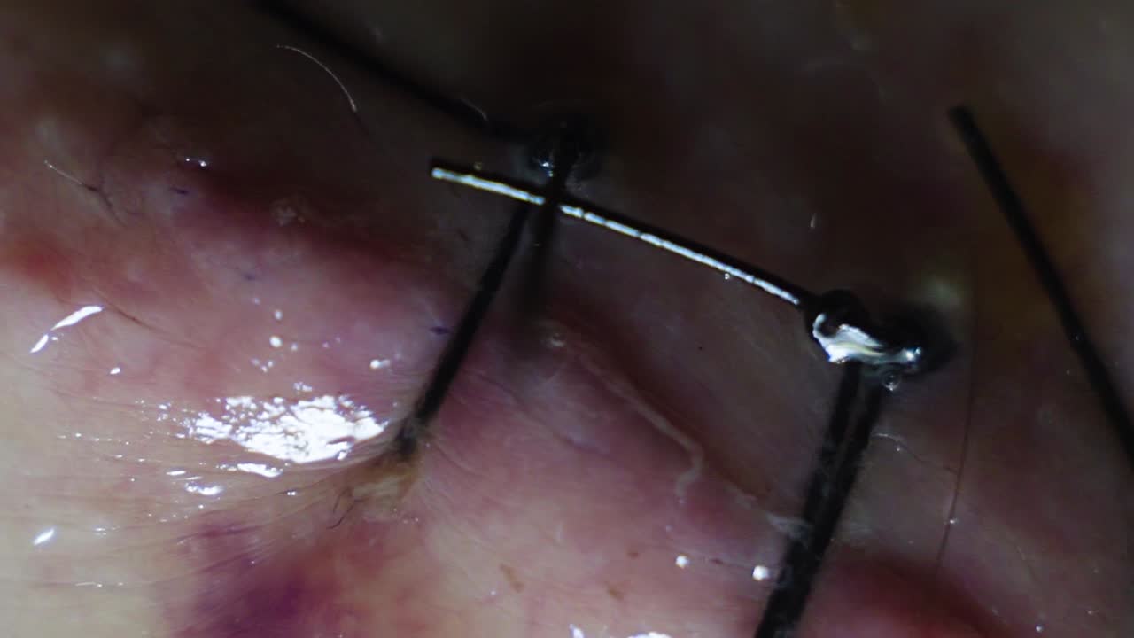 수술 후 백인 남성의 등에 있는 커다란 바늘로 꿰매는 극단적인 극단