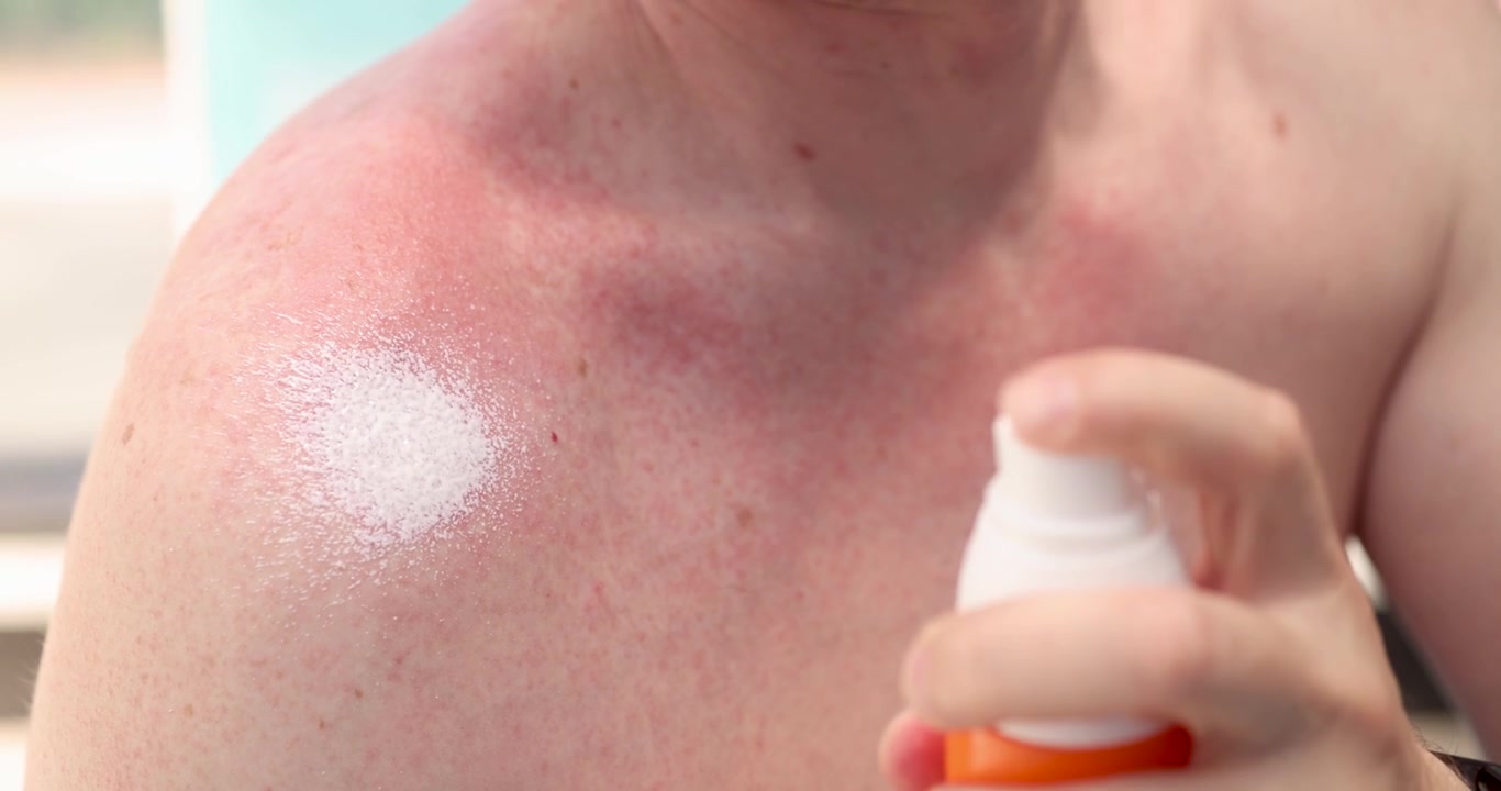 Homem aplicando creme hidratante na pele vermelha e irritada em close-up, filme 4k