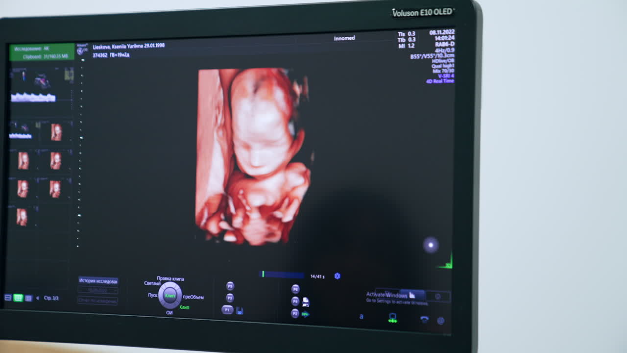 Prenatal image of a baby on the screen of ultrasound equipment. Ultrasonic diagnostics of pregnancy at clinics. Close up.