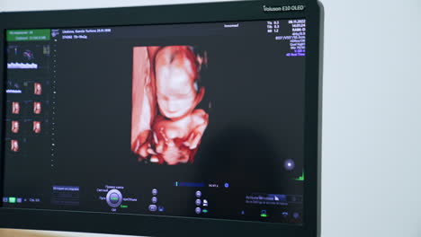 prenatal image of a baby on the screen of ultrasound equipment. ultrasonic diagnostics of pregnancy at clinics. close up.