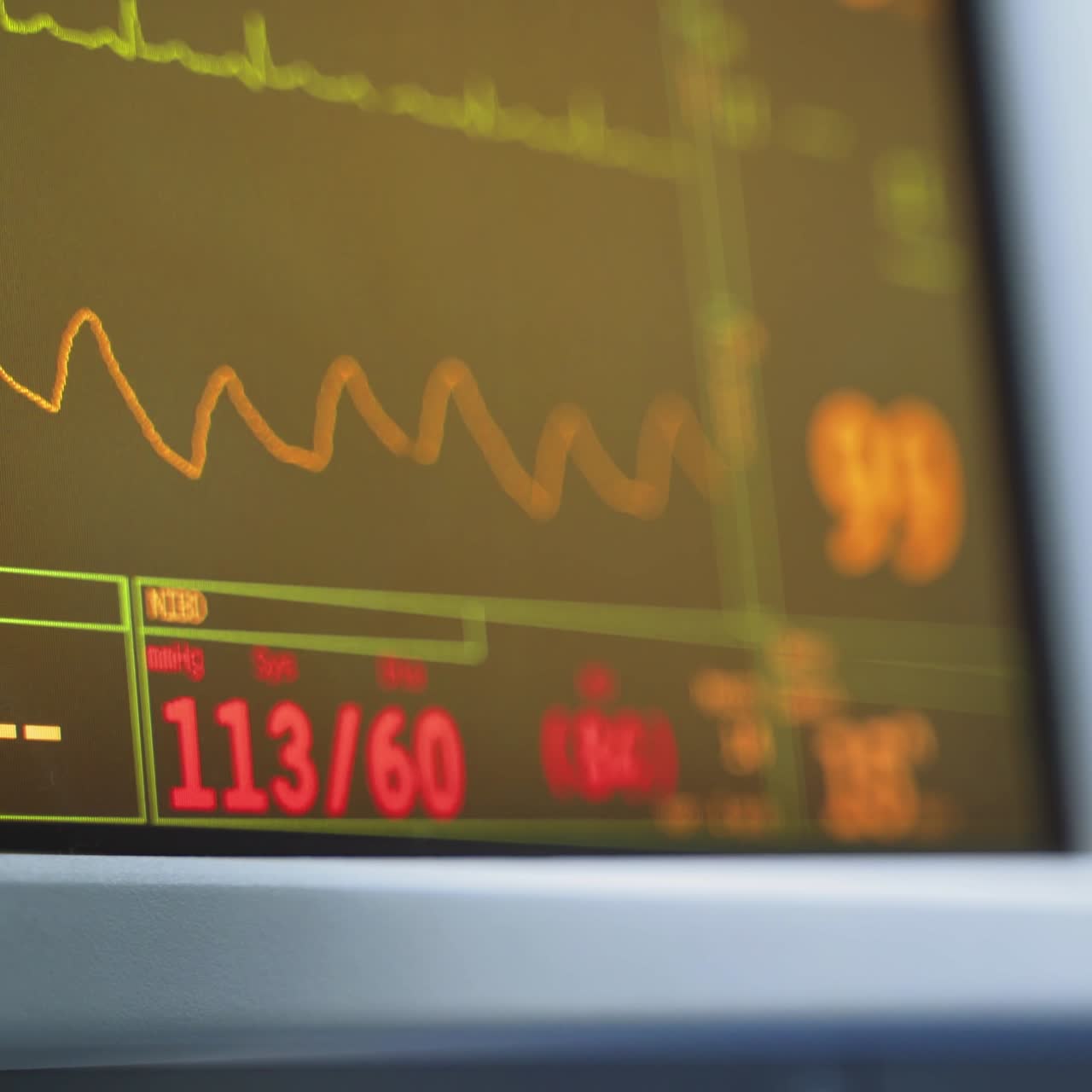 Heart monitor in hospital theatre