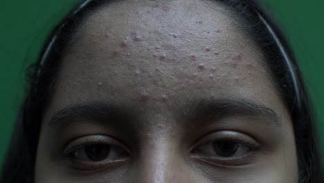 view of female teenager's forehead with acne