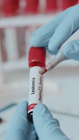 health pro analyzing leukemia blood test in clinical setting