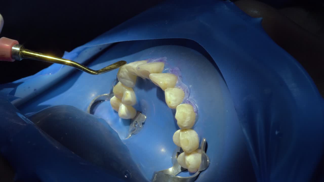 la precisión de la limpieza de los dientes durante la cirugía como un dentista utiliza hábilmente las herramientas