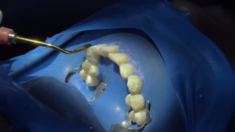 la precisión de la limpieza de los dientes durante la cirugía como un dentista utiliza hábilmente las herramientas