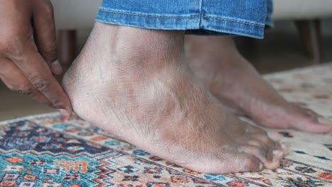 person with dry skin on their feet