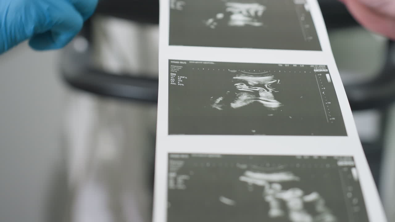 close-up van een arts in medische handschoenen die naar de resultaten van een echografie wijst terwijl hij tijdens een consult verschillende beelden aan de patiënt uitlegt en een duidelijke interpretatie van elk beeld biedt