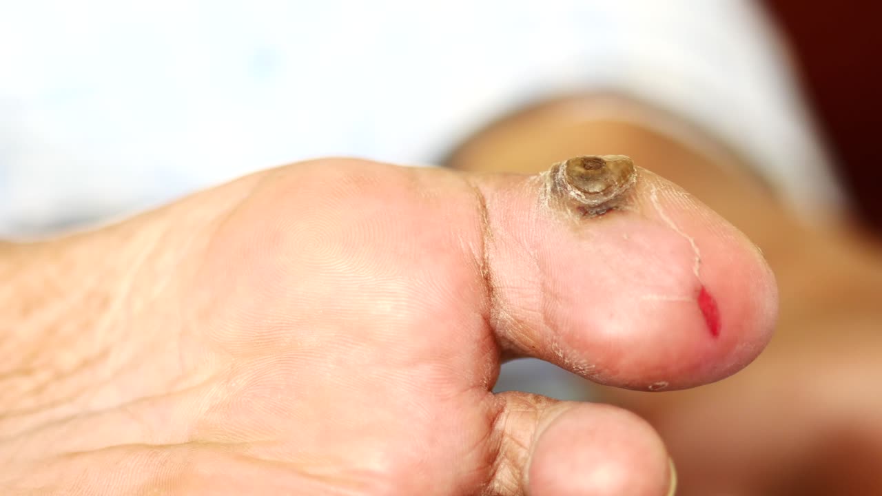 hongos secos en los pies de los hombres mayores ,