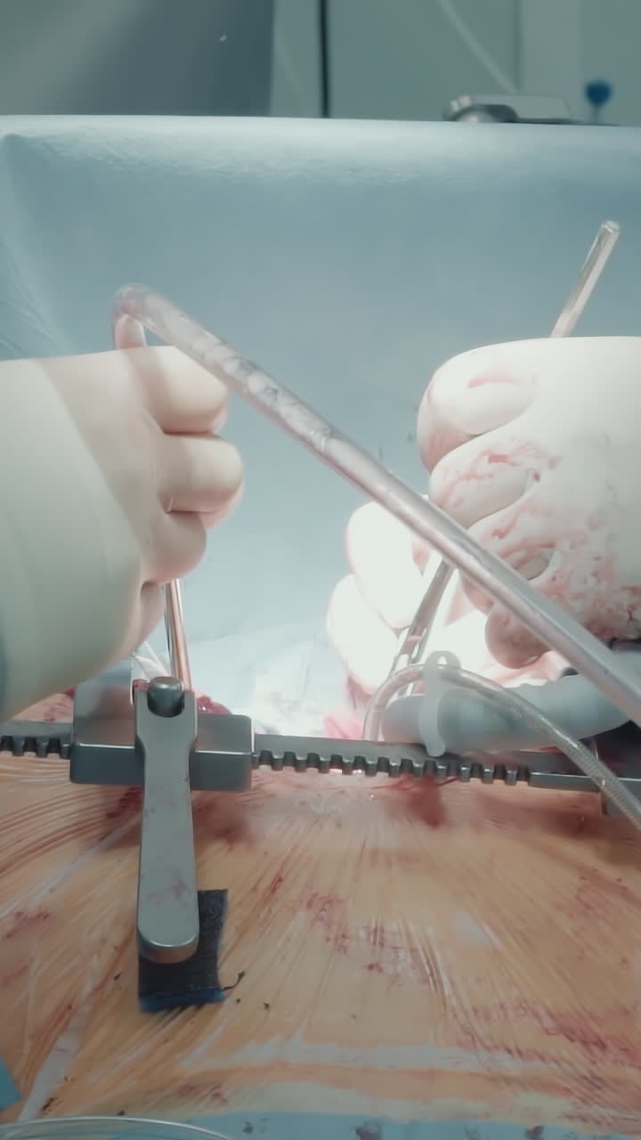 cirujano con enfermera opera al paciente. el médico utiliza instrumentos médicos mientras el asistente controla el dispositivo estabilizador durante el injerto de derivación de la arteria coronaria