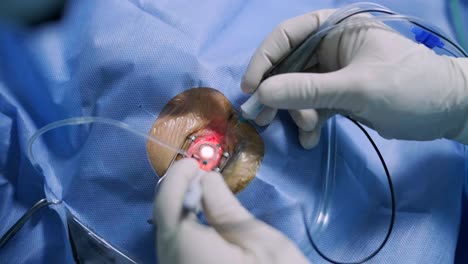 cirugía ocular, vitreoretinal, cirugía de vitrectomía.