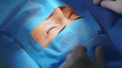 laser vision correction. a patient and team of surgeons in the operating room during ophthalmic surgery. eyelid speculum. lasik treatment. patient under sterile cover