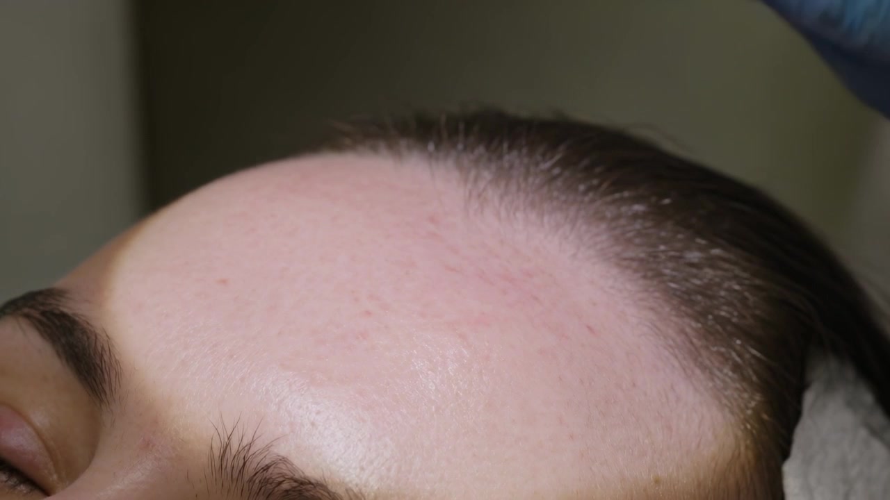 Placing pad, tech wearing blue gloves wiping brow at clinic, applying device treating redness