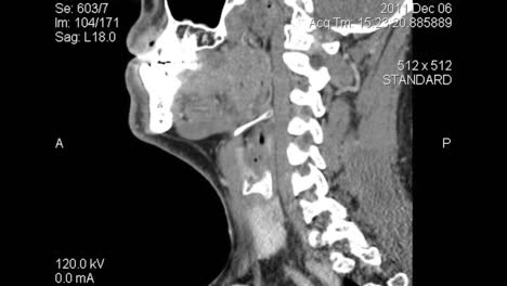 sagittal plane tomography: ct scan layers of lower face and neck