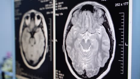mri brain scans
