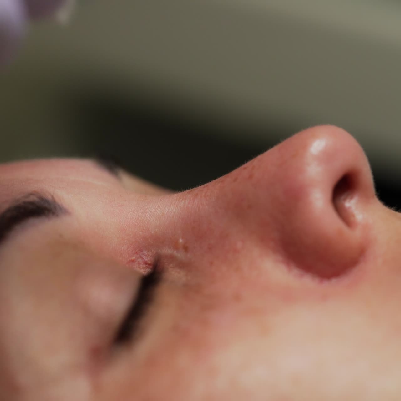 Beauty specialist uses sharp tool to open the pores of a client. Then blackhead removal is applied. Extreme close up