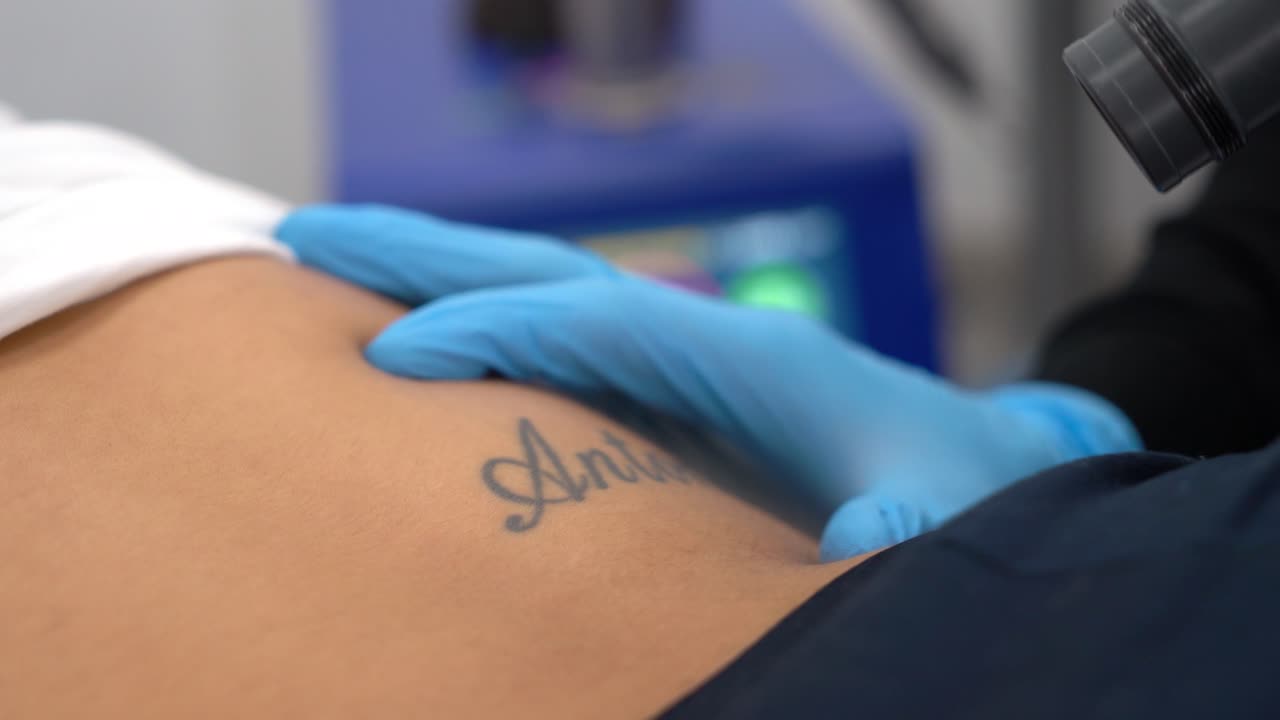 Ragazza che cancella o rimuove un tatuaggio con il nome dell'ex fidanzato