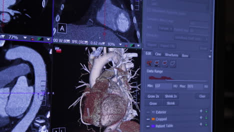 heart scan results, camera tilts down across computer monitor - 4k uhd