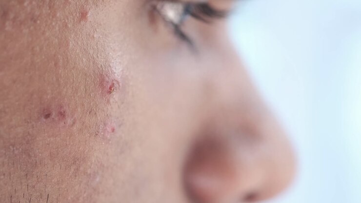 Close-up of acne on a person's face.