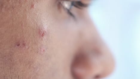 close-up of acne on a person's face.