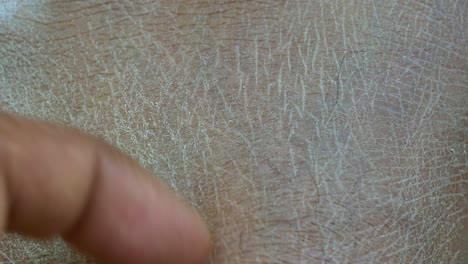 Close-up image of dry, cracked skin on a person's hand