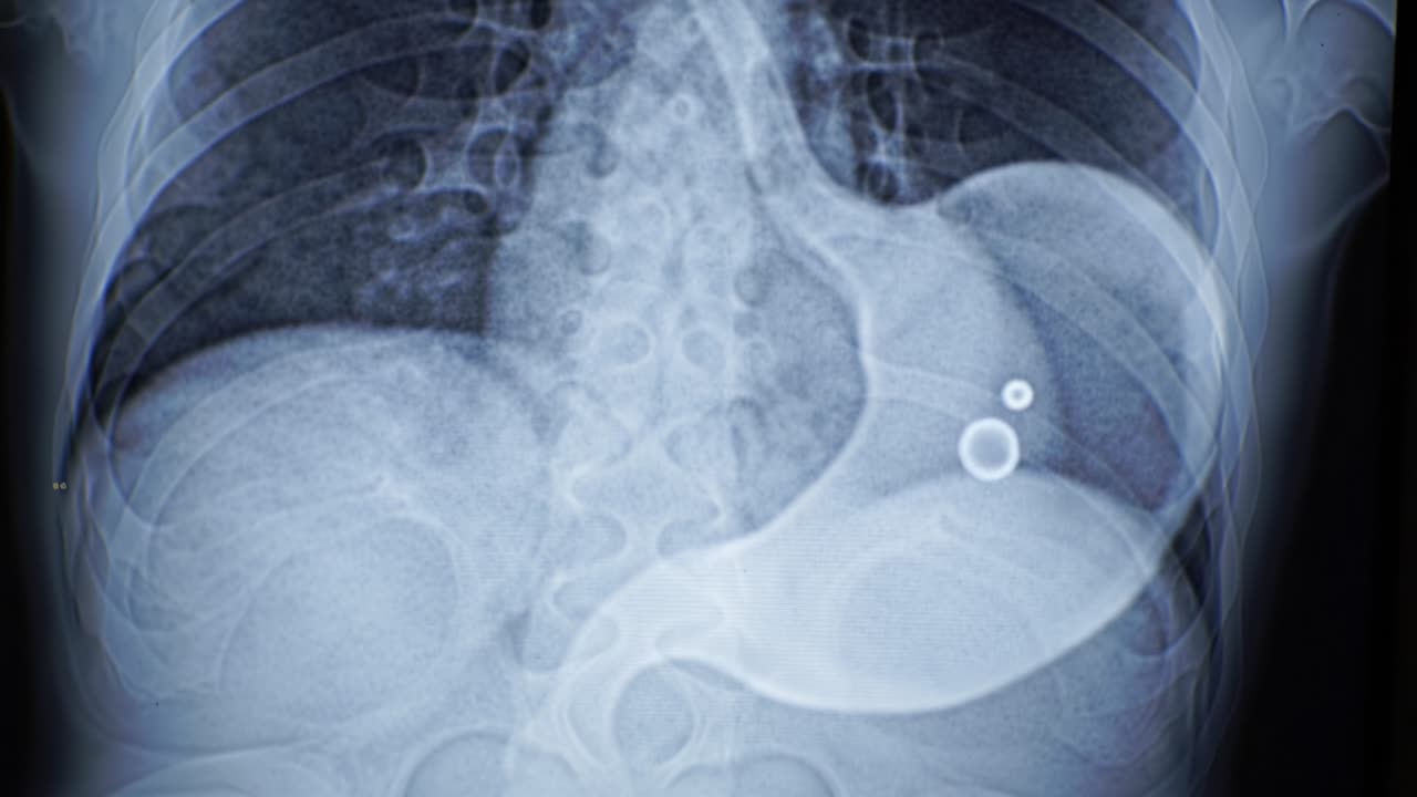 A detailed view of a human stomach and esophagus is shown, highlighting an air bubble within the digestive tract. This visualization aids in understanding digestive health.