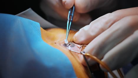 corrección de la visión con láser. un paciente y un equipo de cirujanos en la sala de operaciones durante una cirugía oftalmológica. especulo del párpado. tratamiento de lasik. paciente bajo una cubierta estéril