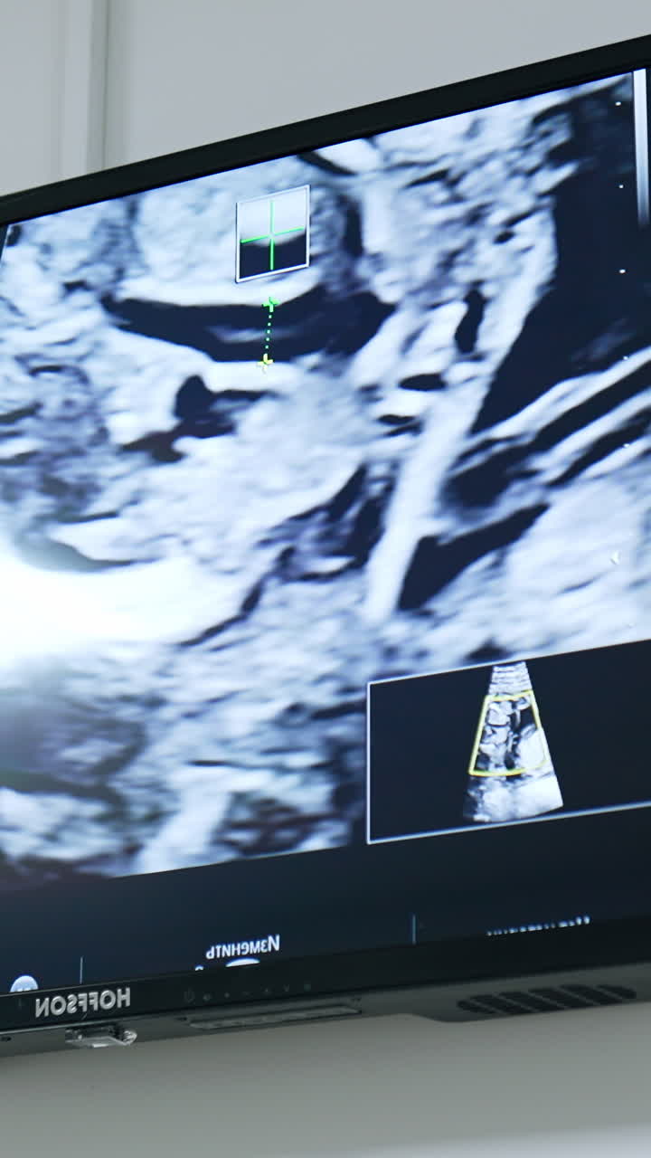 Black and white screen with the image of ultrasound scan. Pregnancy check up at clinics. Vertical video