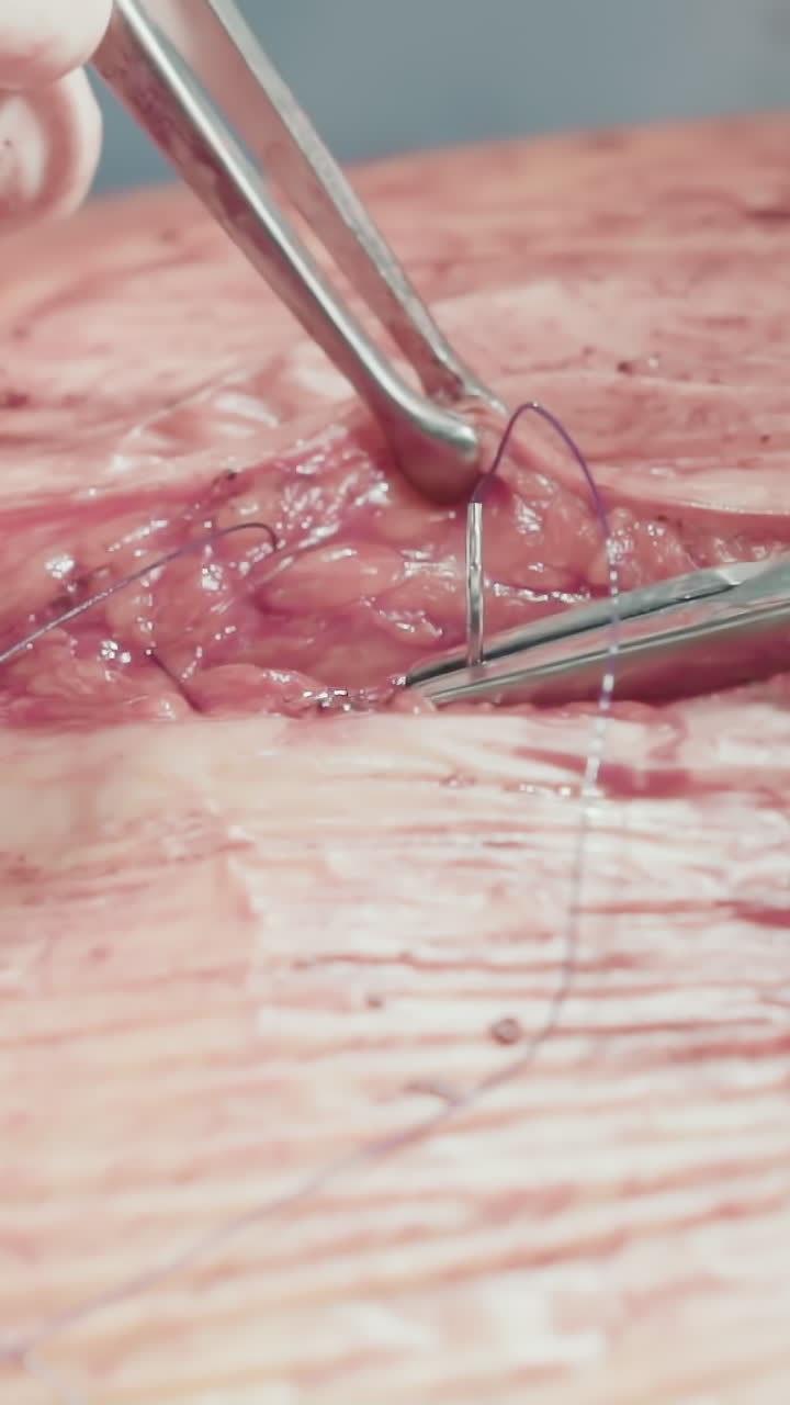 el médico cierra la incisión con suturas. un cirujano experimentado inserta cuidadosamente la aguja que trabaja en la cavidad después de la cirugía de derivación de la arteria coronaria