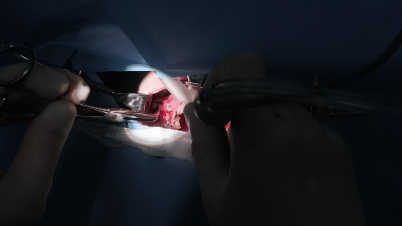 Operation of removing tonsils under deep anesthesia, throat close up, surgeon uses latest devices, cold plasma method, cuts swelling in throat, doctor works with new probe