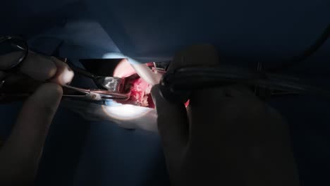 operation of removing tonsils under deep anesthesia, throat close up, surgeon uses latest devices, cold plasma method, cuts swelling in throat, doctor works with new probe