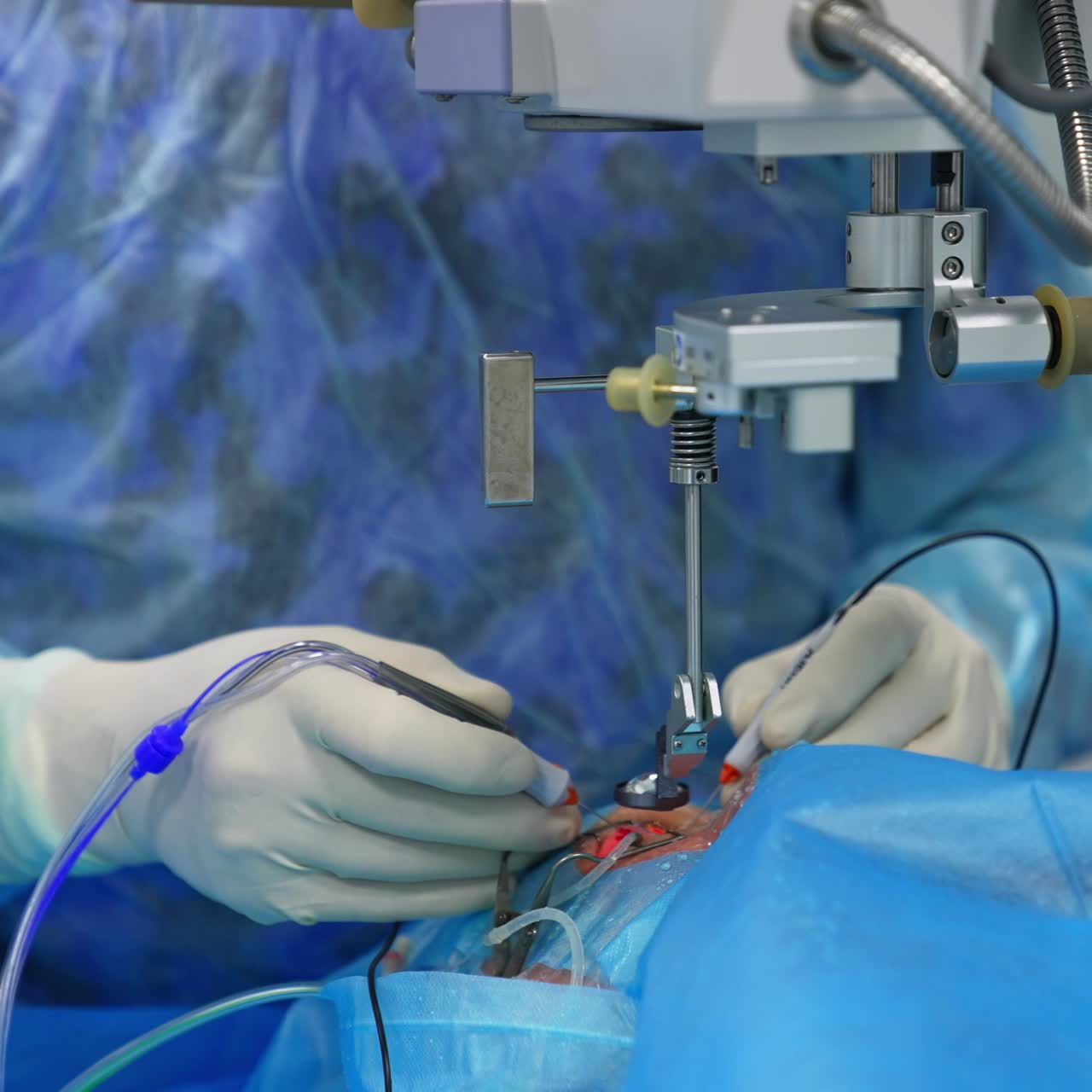 Surgeon's hands operate with tools in the eye of a patient. Special equipment hovering over the operating table for the precise result