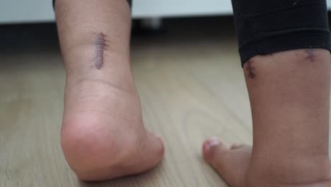 close up of a scar on a person's ankle