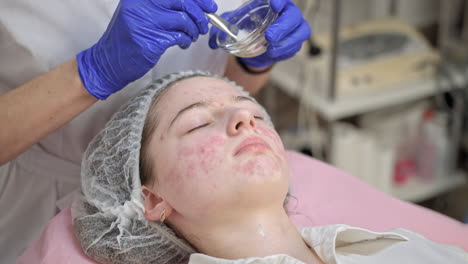 facial treatment for acne