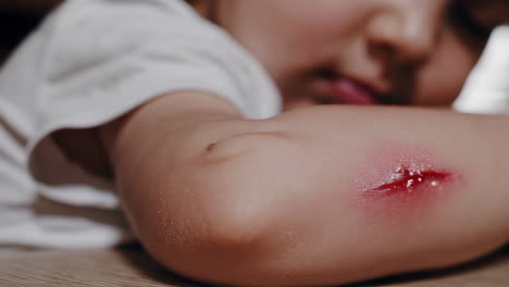 Child with a cut on their arm