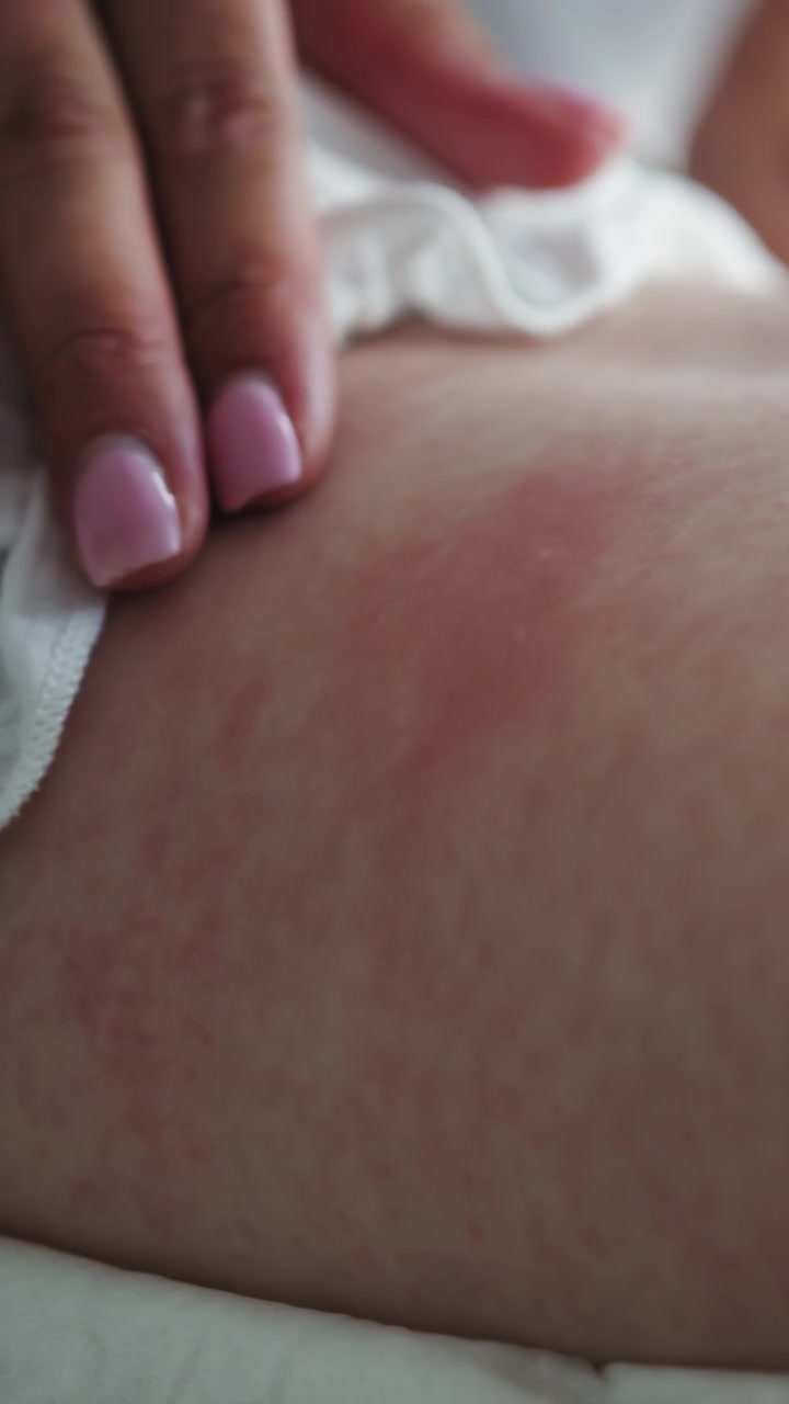Vista dettagliata della pelle di un neonato che mostra chiazze rosse infiammate e piccole protuberanze indicative di un'eruzione cutanea o