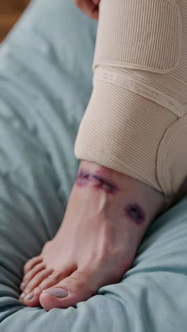 injured ankle with brace and bruises