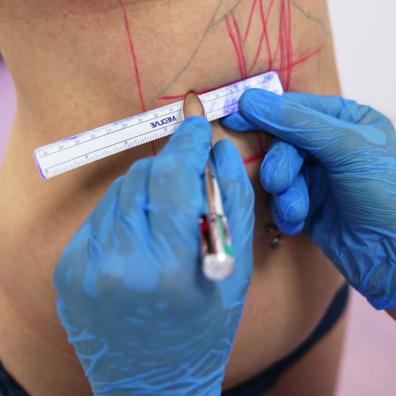 Mani del medico con i guanti che misurano le linee sull'addome della paziente con un righello. Il chirurgo traccia una linea rossa verso il basso.