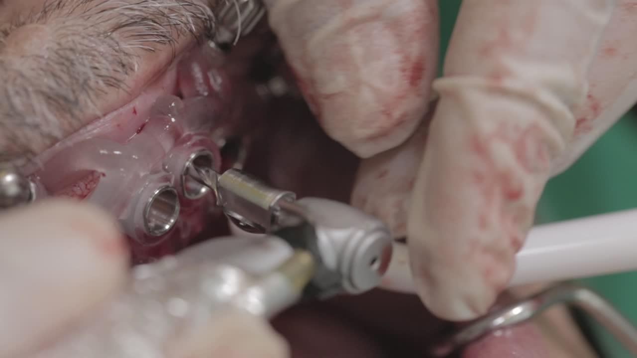 Dentist using dental drill to create holes in patient’s mouth for implant procedure