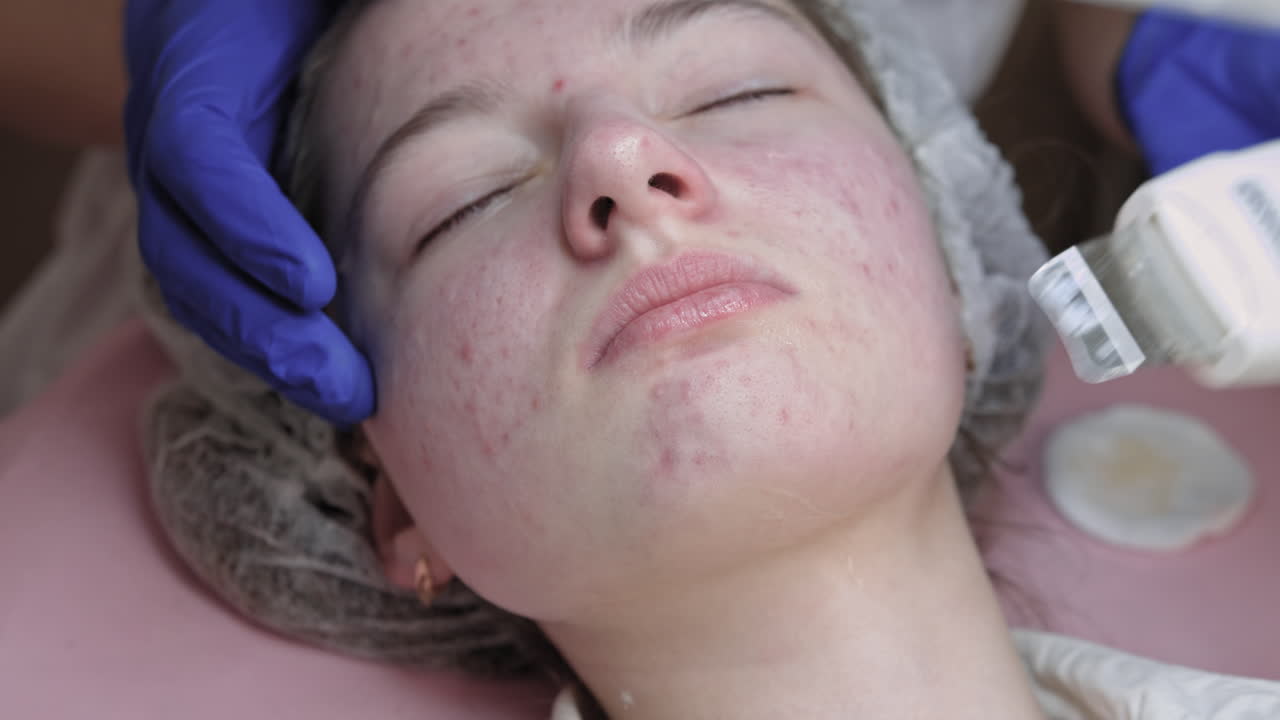 Acne Treatment Facial