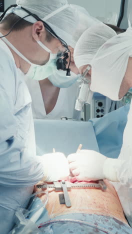 los médicos unen el vaso del injerto con hilo. los cirujanos cardiotorácicos expertos realizan una cirugía de derivación de la arteria coronaria creando una nueva vía para el flujo sanguíneo