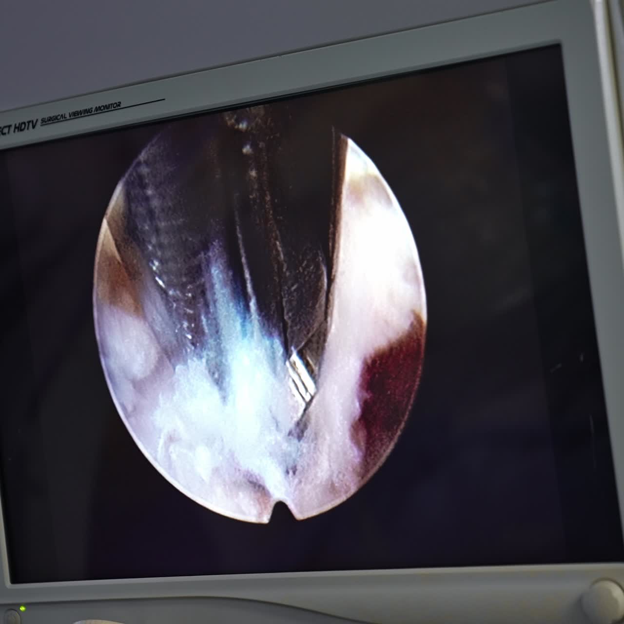 Screen showing the point of intervention. Monitor with the picture of high-precise instrument moving back and forth in patient's body