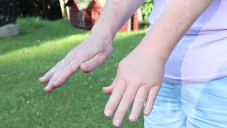 Comparison-of-two-female-hands-stung-by-bee-or-wasp