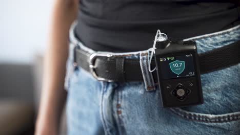 Insulin-pump-on-waist-belt-of-female-diabetes-patient,-close-up