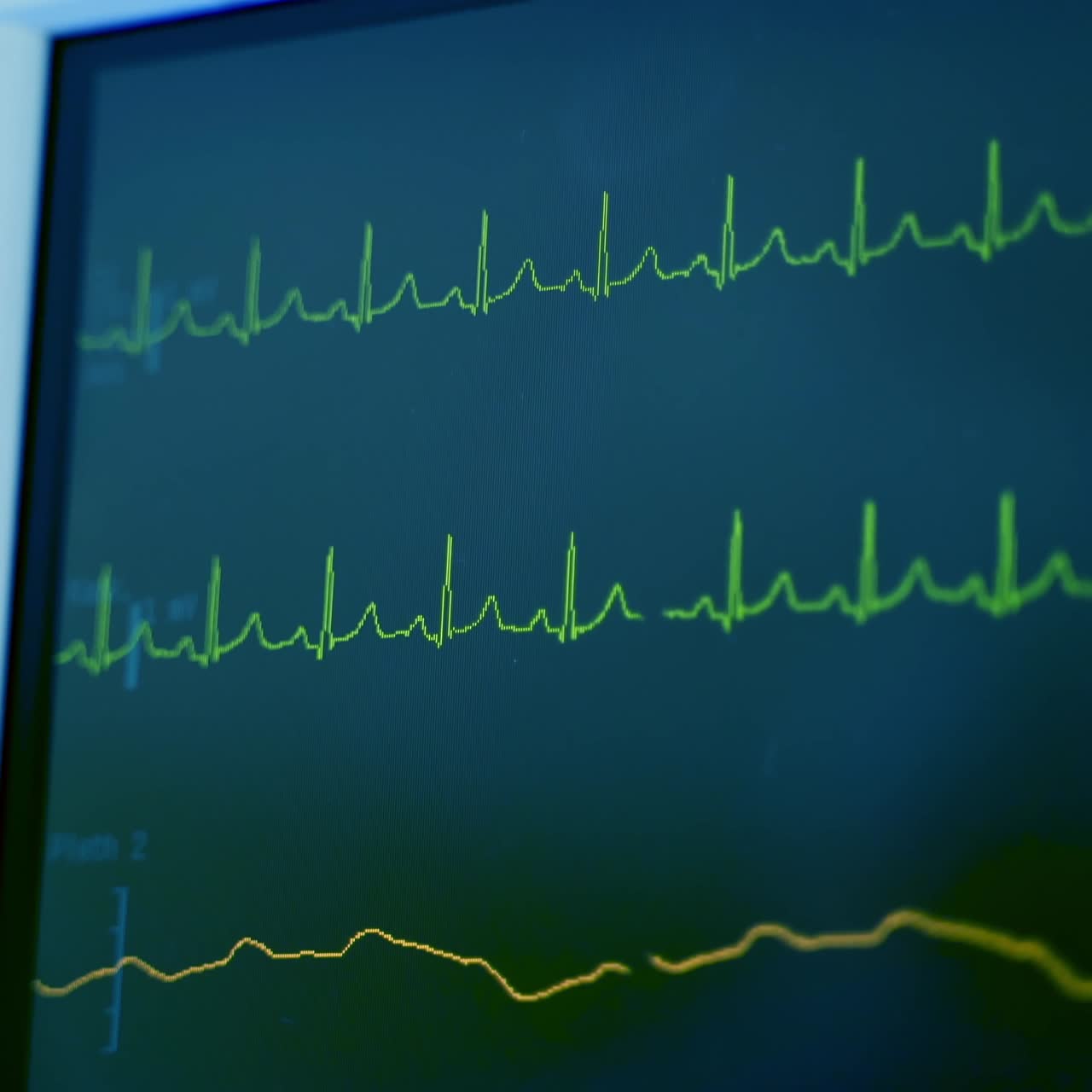 Motion of graphics on the screen of monitor. Monitor displays patient's vital signs ECG. Oxygen saturation and respiration. Close-up.